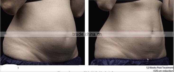 New fat killer HIFU slimming machine