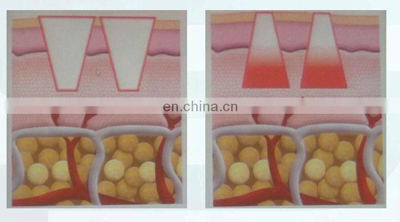 Fractional RF machine- GSD Dermatrix