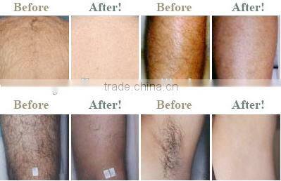 Vertical IPL OPT SHR Hair Removal Machine