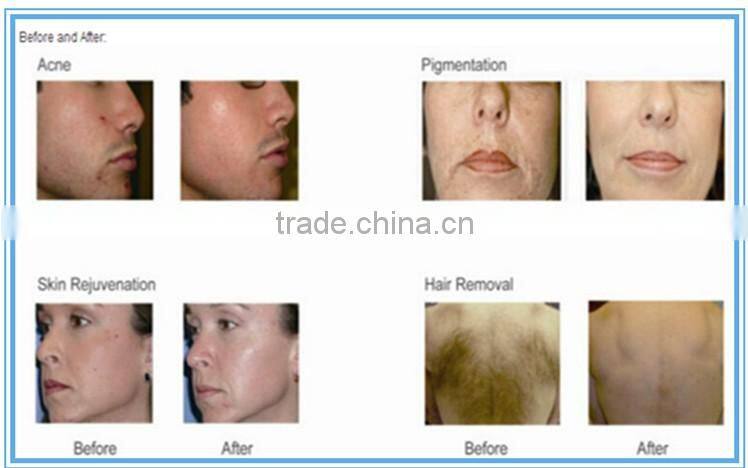 laser hair removal machine ipl hair removal yag 2016