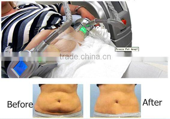 Cryolipolysis vacuum liposuction machine price