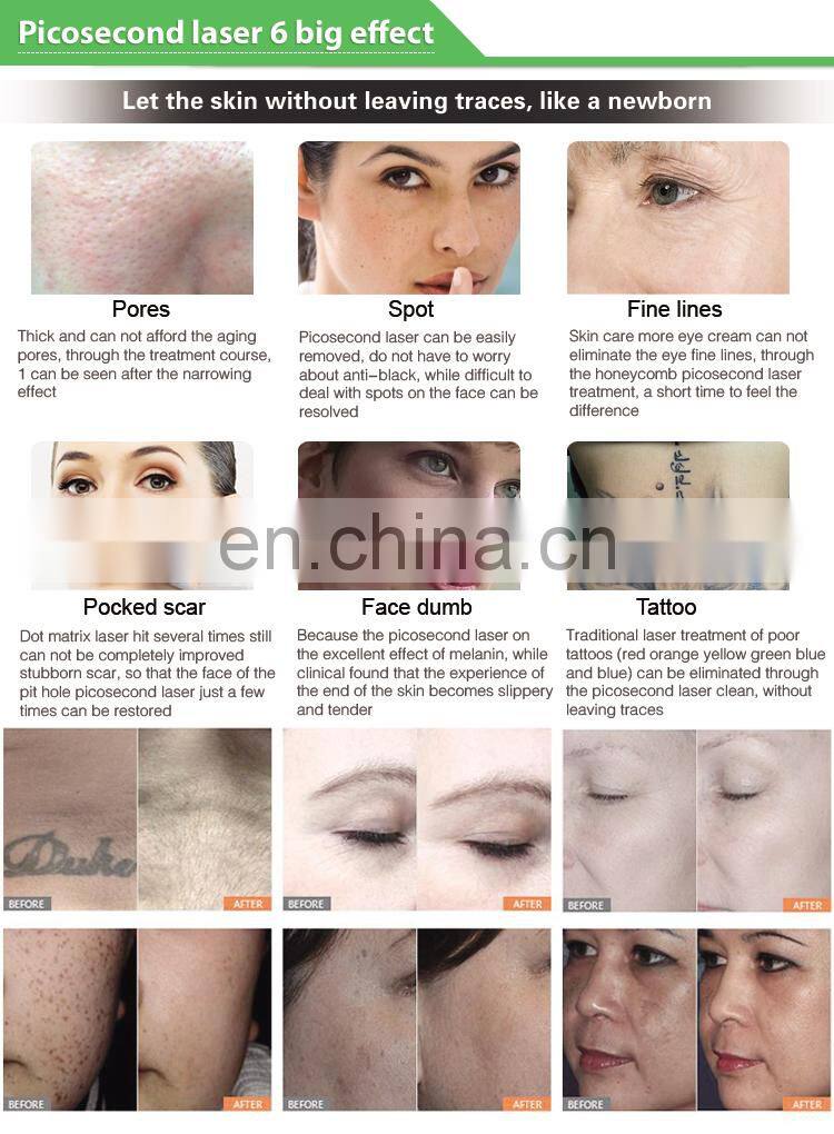 Super Pico laser 755nm tatoo removal/dark spots removal machine