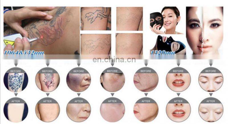 2020 Hot Sale Touch Screen 2000mj Tattoo Removal Laser Machine China Laser ND YAG Laser