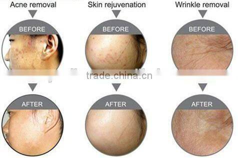 LED Light Phototherapy Facial Skin Care Beauty Device