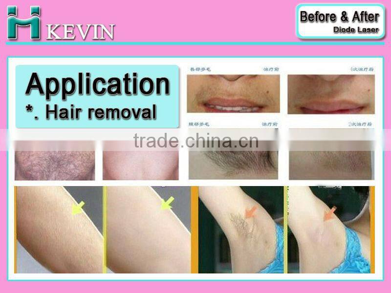 New Design SFDA, TGA certified medical machine 808nm Portable Diode Laser hair removal machine