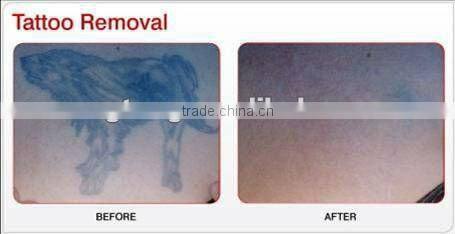 new high energy Q-switched ND YAG laser tattoo removal machine