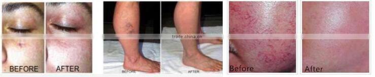 permanent remove vascular machine by 980nm diode laser