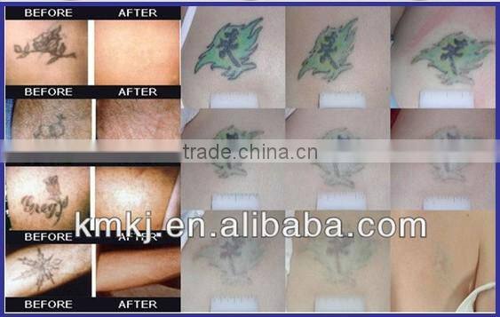 Weifang KM q switch nd yag laser tattoo removal machine price