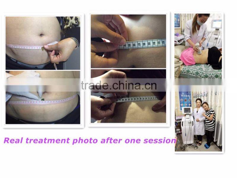 2016 best selling body slimming beauty machine liposonix machine loss weight