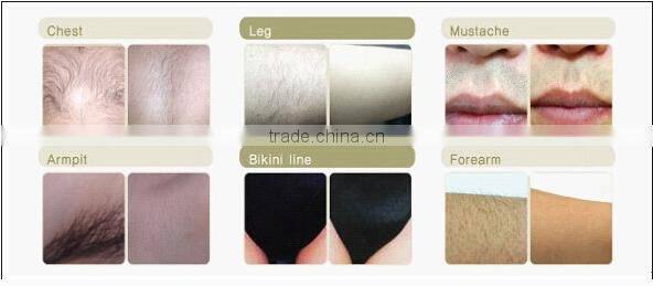 Y8B Portable 808nm Diode Laser Hair Remoal Machine with Germany Bar