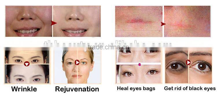 YYR high quality home use 0.5mm eyes derma rolling system 540 needles latest derma roller