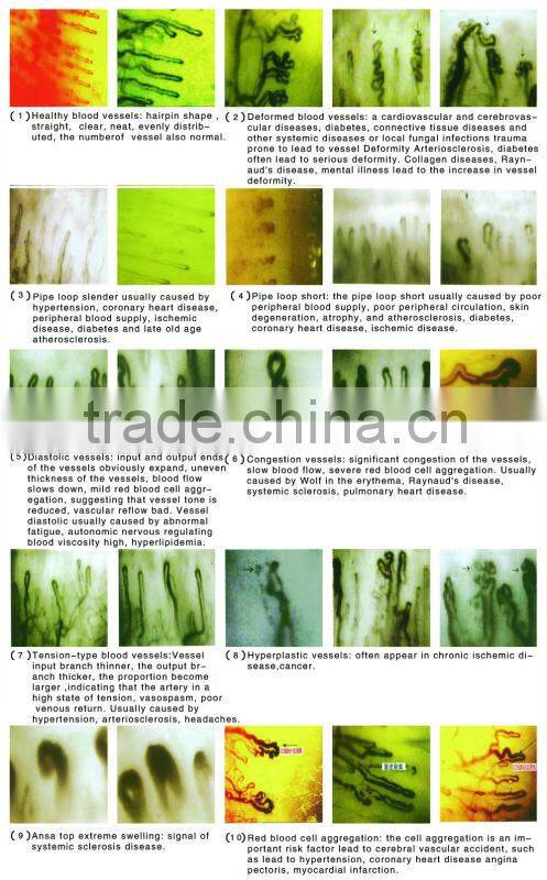 nail fold microcirculation microscope capillaroscope video microcirculation microscope capillary microscope