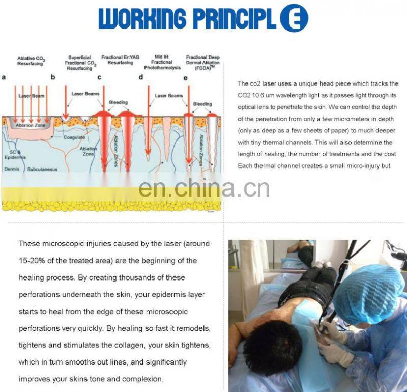 Low price portable co2 fractional laser for scar removal & acne treatment