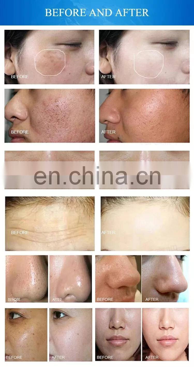 8 In 1 Bubble Facial lifting Water Peel Skin Rejuvenationl Beauty Microdermabrasion machine