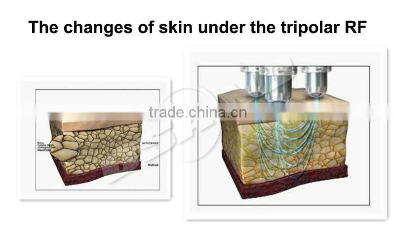 Vacuum Radio frequency photon eye lifting beauty machine