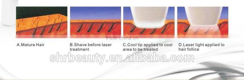 Hot sale 808nm Diode Laser Depilation Upper Lip Hair Removal Machine