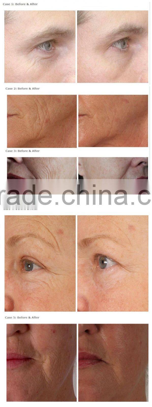 GTO 540 needles titanium derma rollers