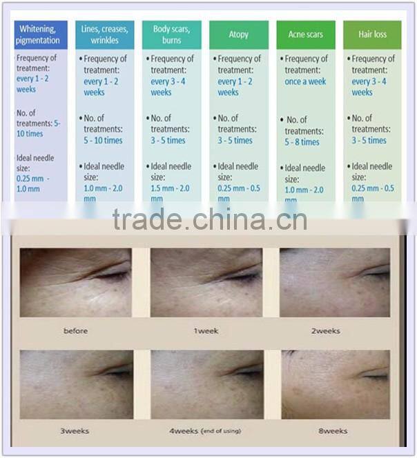 Micro Needle Therapy System 180 Derma Rolling System