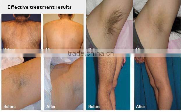 Wholesale custom for sale laser hair removal machine,low price powerful ipl hair removal machine