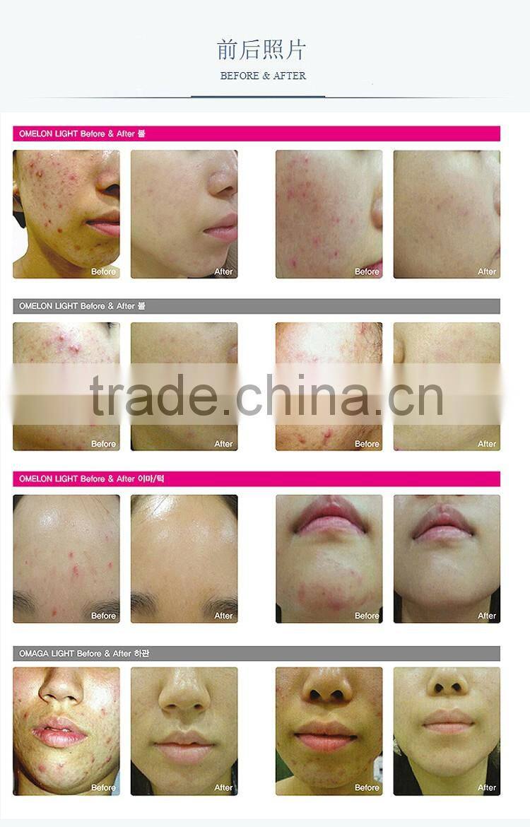 OME/ODM red blue yellow green led light therapy PDT machine for skin care