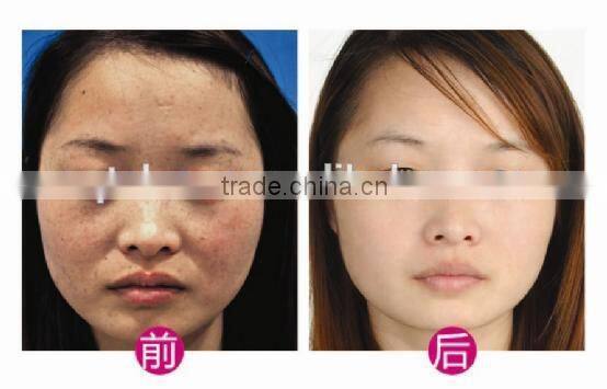 Quality Q Switch Nd:YAG Laser Machine For Skin Rejuvenation, Tattoo Removal / Birth Mark Removal manufacturer