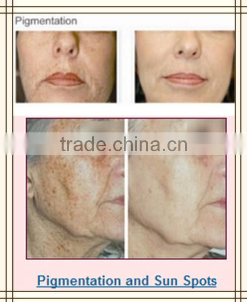 High quality 1064nm 532nm 1320nm Q switch nd yag