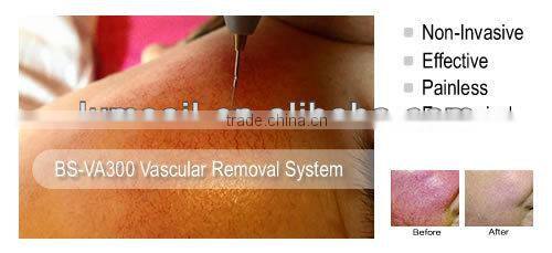 Spider Vein Removal machine Capillary Removal equipment
