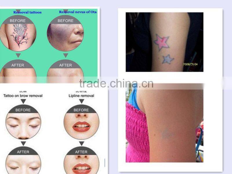 Portable Q switch nd yag Laser tattoo removal machine