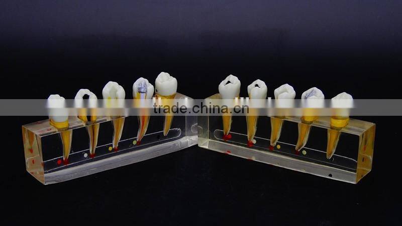 Dental endodontics disease demonstration teeth model 2 DEA-50