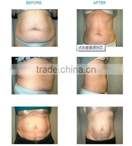 650nm diode laser ultra lipolysis lipo slimming machine CS02