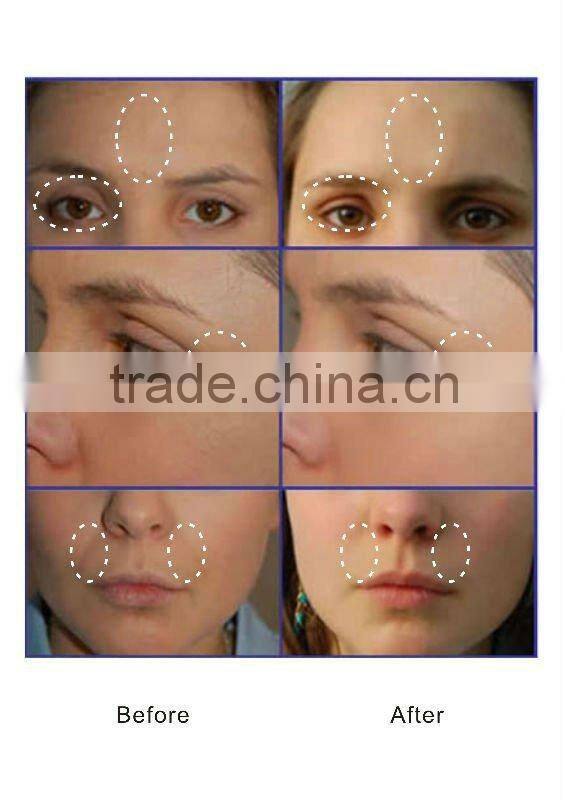 2015 New microcurrent skin tightening machine skin toning therapy