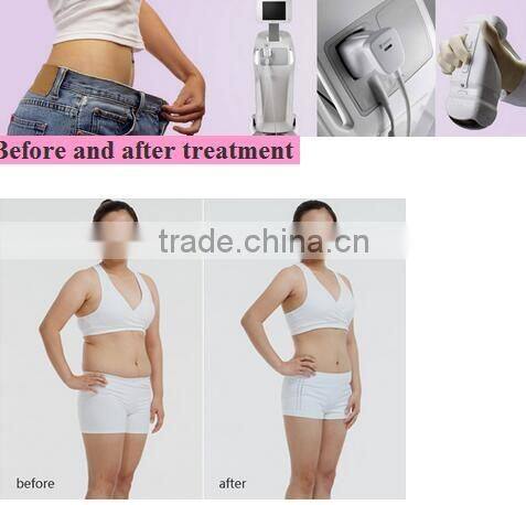 Best design ultrasound leading slimming machine liposonix slimming for sale