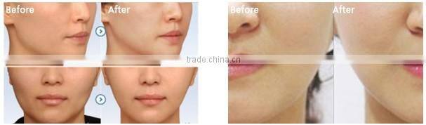 keywords cavitation rf machine rf cavitation machine cavitation rf slimming machine