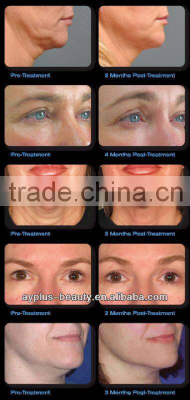 AYJ-H076(CE) ultrasonic facial massager