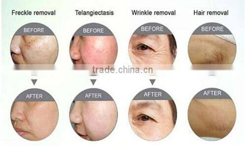 IPL Beauty Equipment / Portable ipl+rf / IPL hair removal portable BR101