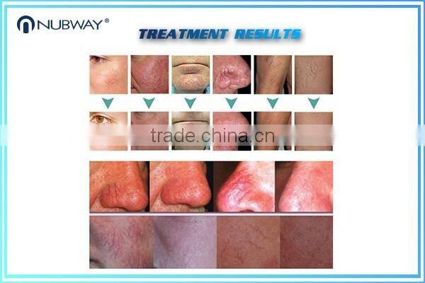 Hot selling ! Vascular Lesions /Spider Veins / Facial Laser Veins Removal