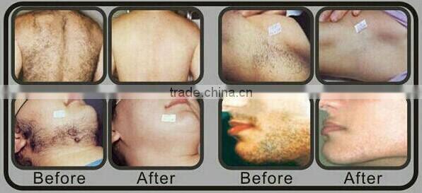 2016 most hot sale super hair removal ipl shr / shr ipl depilation / shr hair removal machine for sale