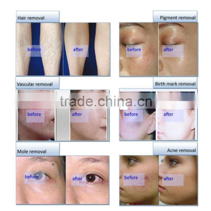 Best promotion price ipl e-light machine hair removal ipl hair removal machine