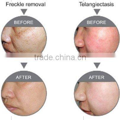 WL-03 E-light (ipl+rf) skin care and hair removal machine