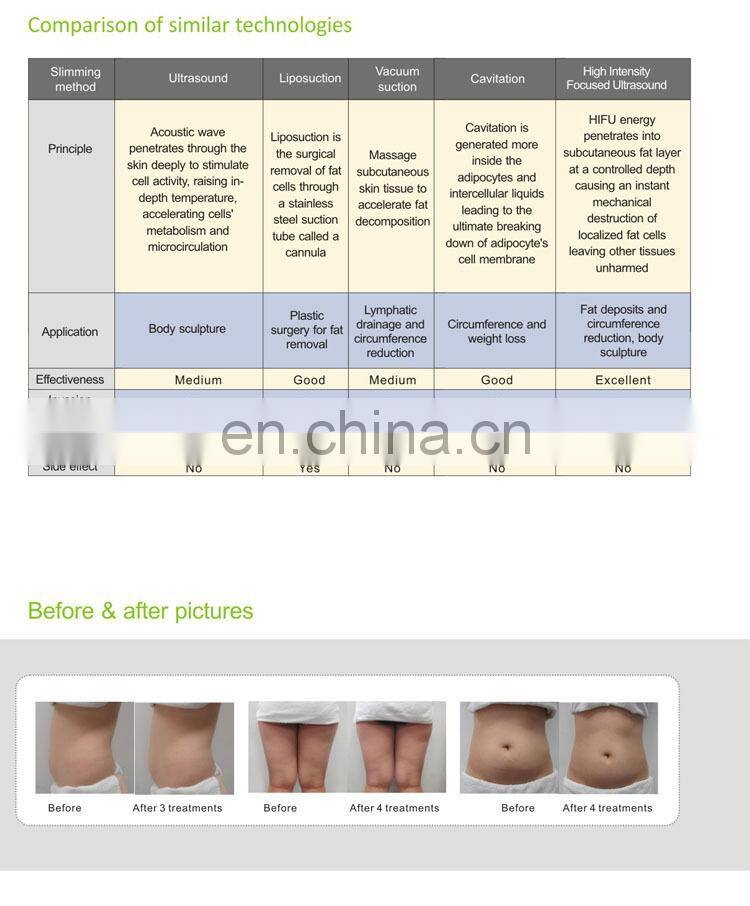 Latest Technology SMAS home HIFU for wrinkle removal system home hifu ultrasound medical treatment