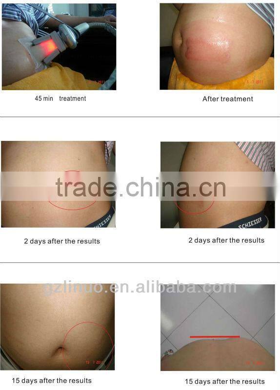 2013-2017 the most professional+powerful+Effective froze fat machine ( Amazing-Reduce 26% fat one time!!)