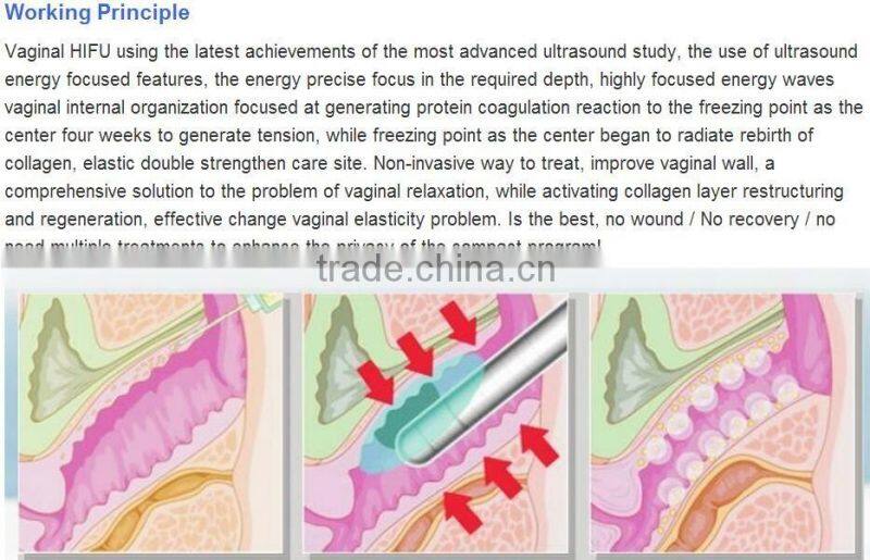 AYJ-SS09 ayplus ultrasound hifu machine vaginal