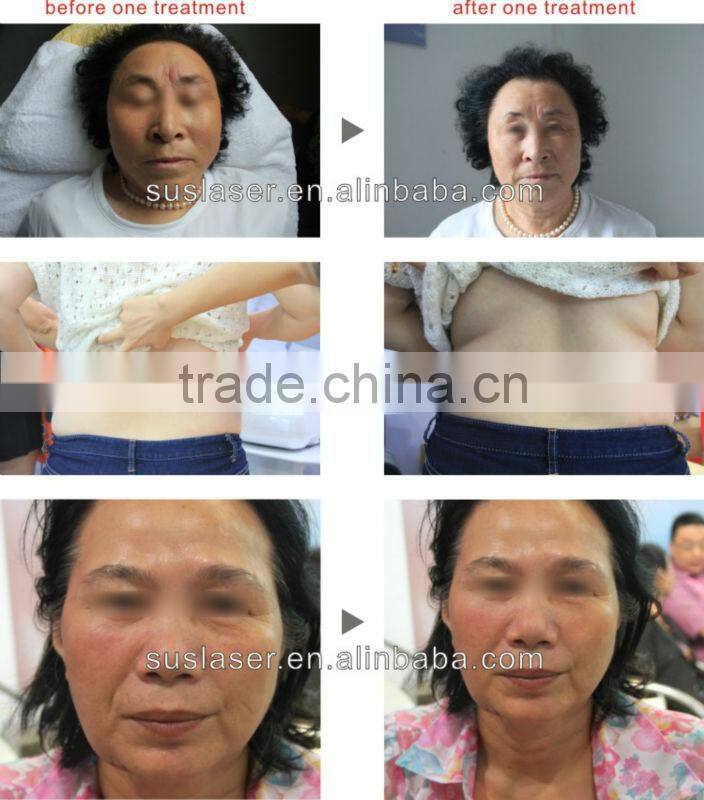 Quickly Natural Weight Loss Tips Perfect Slimming-Velaslim Vacuum Roller Massage Machine