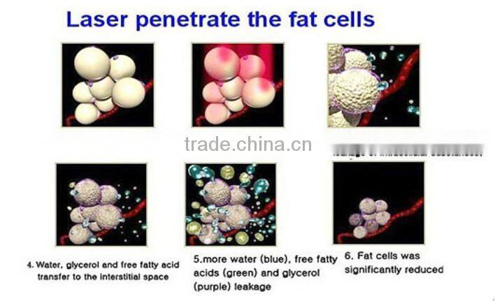New Product hot diode laser Weight Loss smart lipo laser/lipo laser slimming