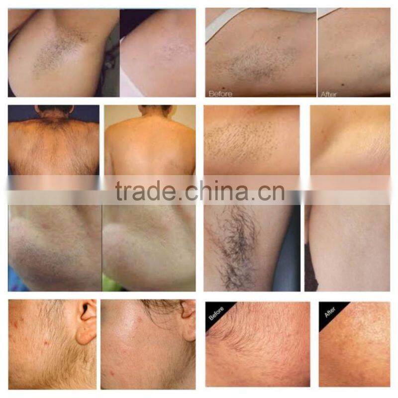 ipl laser hair removal machine for sale/ipl laser hair removal machine