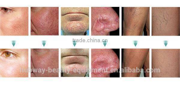 Professional painless spider vein removal for removal soften blood vessels