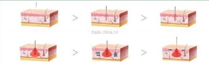 High performance !!! best fractional rf needle for sale