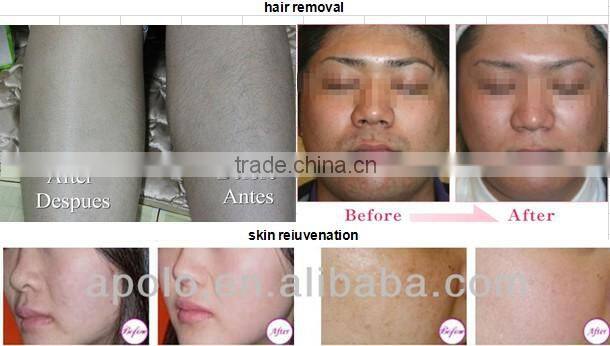 Easy use 808 diode laser hair removal beauty machine