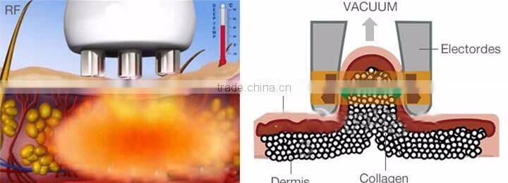 Ultrasonic liposuction cavitation focused slimming machine for sale