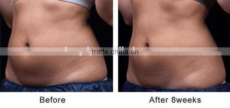 2016 liposonix hifu slimming equipment / liposonix LANGDI ORIGINAL FACTORY